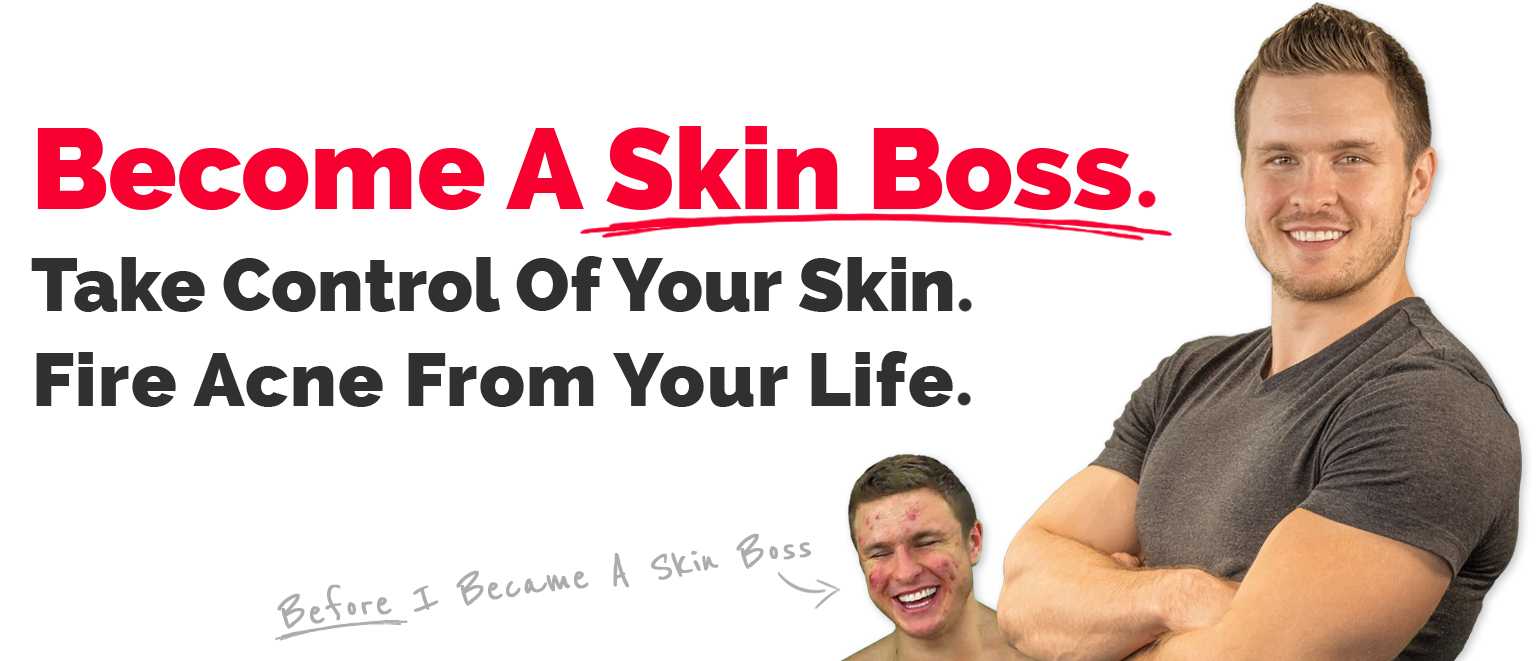 In red text, "Become A Skin Boss" in black text underneath, "Take Control of Your Skin. Fire Acne From Your Life".  White male standing with arms crossed and clear skin.  A smaller picture of the same male with acne and the words "before i became a skin boss". 